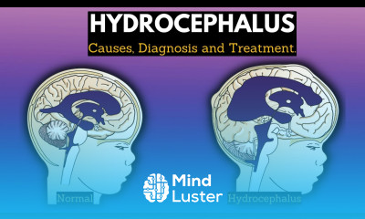 Hydrocephalus Causes Signs and Symptoms Diagnosis and Treatment