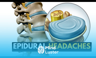 Epidural Headaches What You Need To Know