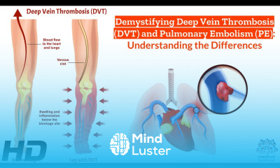 Vein Vigilance A Deep Dive into DVT and Pulmonary Embolism