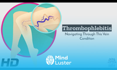 Thrombophlebitis 101 Navigating the Challenges of Vein Conditions