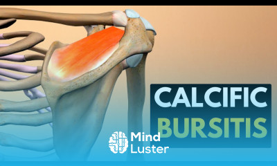 Calcific Bursitis Causes Signs and Symptoms Diagnosis and Treatment