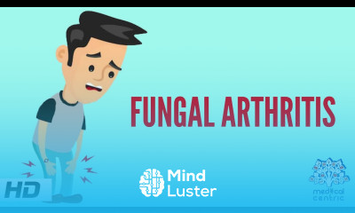 Fungal Arthritis Causes Signs and Symptoms Diagnosis and Treatment