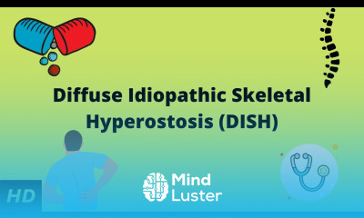 Diffuse Idiopathic Skeletal Hyperostosis DISH Causes Signs and Symptoms Diagnosis and Treatment