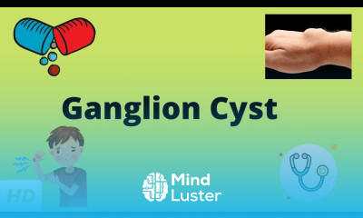 Ganglion Cyst Causes Sign and Symptoms Diagnosis and Treatment