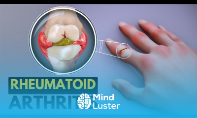Rheumatoid Arthritis Causes Signs and Symptoms Diagnosis and Treatment
