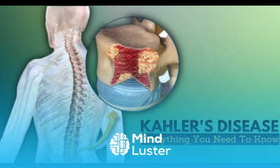 Kahler s Disease Causes Signs and Symptoms Diagnosis and Treatment