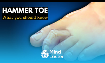 Hammer Toe or Mallet Toe Causes Signs and Symptoms Diagnosis and Treatment
