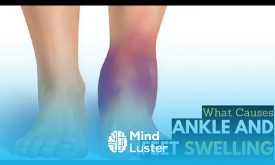 What Causes Ankles Feet Swelling Diagnosis Treatment