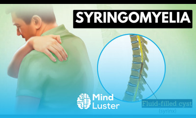 Syringomyelia Everything You Need To Know
