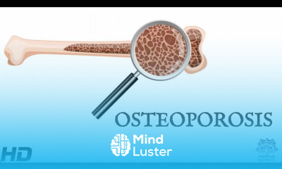 Osteoporosis Everything You Need To Know