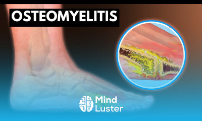 Osteomyelitis What You Need To know