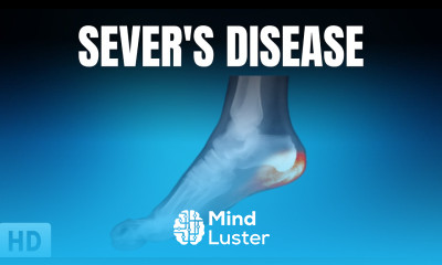 Sever s Disease Everything you need to know