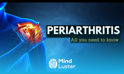 Periarthritis Everything You Need to Know