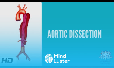 Aortic Dissection Causes Signs and Symptoms Diagnosis and Treatment