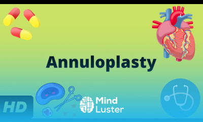 Annuloplasty What You Need to Know