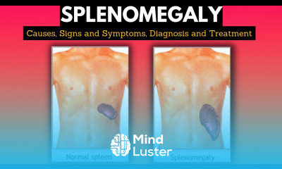 Splenomegaly Causes Signs and Symptoms Diagnosis and Treatment