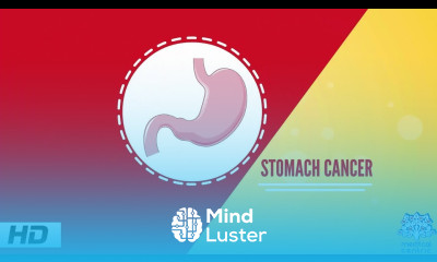 Stomach Cancer Causes Signs and Symptoms Diagnosis and Treatment