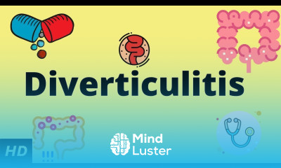 Diverticulitis Causes SIgns and Symptoms Diagnosis and Treatment
