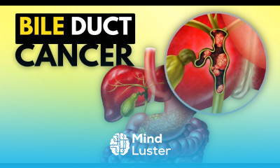 BIle Duct Cancer Cholangiocarcinoma Causes Signs and Symptoms Diagnosis and Treatment