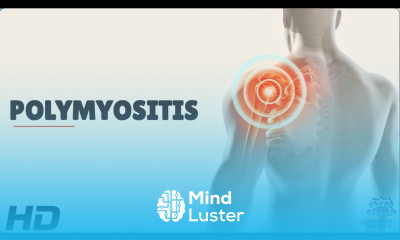 Polymyositis Understanding the Rare Autoimmune Disease