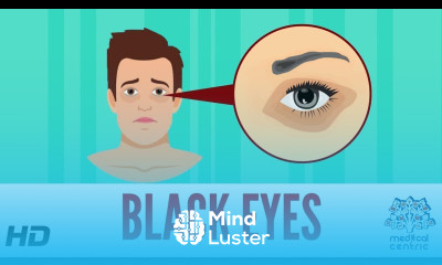 Black Eye Causes Signs and Symptoms Diagnosis and Treatment