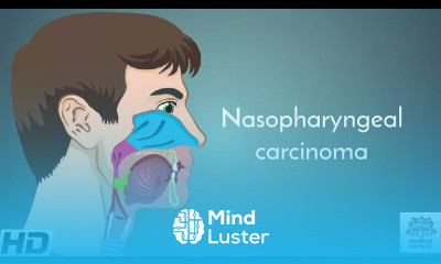 Nasopharyngeal carcinoma Causes Signs and Symptoms Diagnosis and Treatment