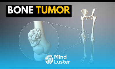Bone Tumor Causes Signs and Symptoms Diagnosis and Treatment