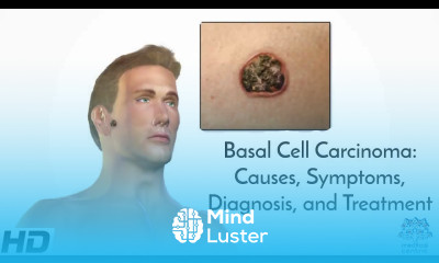 Basal Cell Carcinoma Causes Symptoms Diagnosis and Treatment
