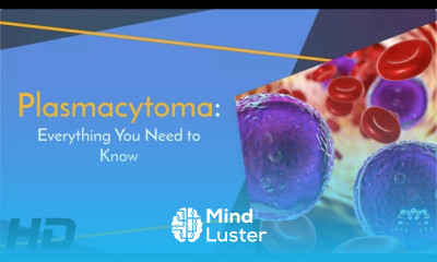 Plasmacytoma The Silent Cancer You Need to Know About
