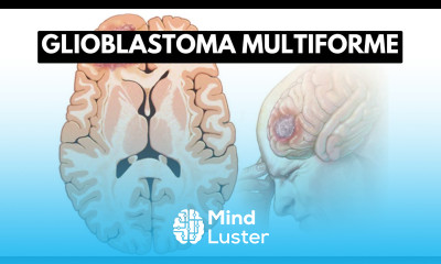 Inside Glioblastoma Multiforme A Journey into the Deadliest Brain Tumor
