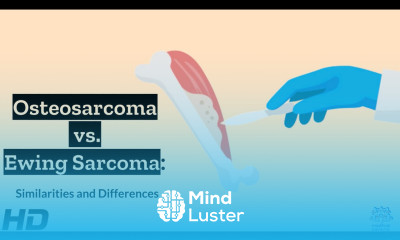 Osteosarcoma vs Ewing Sarcoma A Comparative Analysis