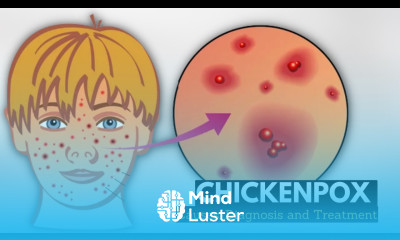 Chickenpox Causes Signs and Symptoms Diagnosis and Treatment