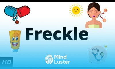 Freckle Causes Signs and Symptoms Diagnosis and Treatment