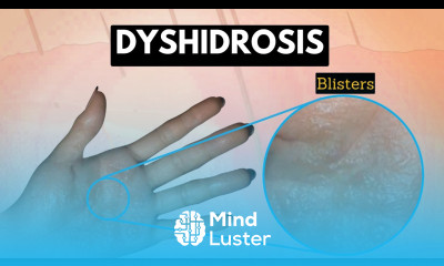 Dyshidrosis Causes Signs and Symptoms Diagnosis and Treatment