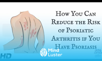 How You Can Reduce The Risk Of Psoriatic Arthritis If You Have Psoriasis