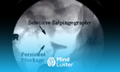 Selective Salpingography for blocked fallopian tubes
