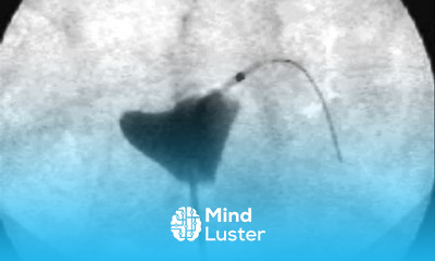 Opening a fallopian tube