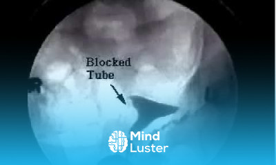 Blocked fallopian tube