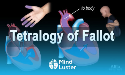 Congenital Heart Disease Tetralogy of Fallot Animation