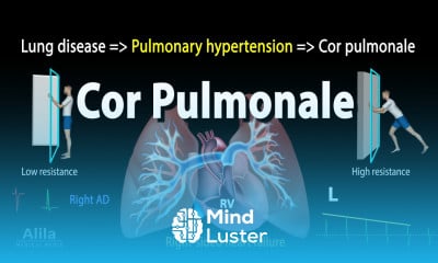 Cor Pulmonale Animation