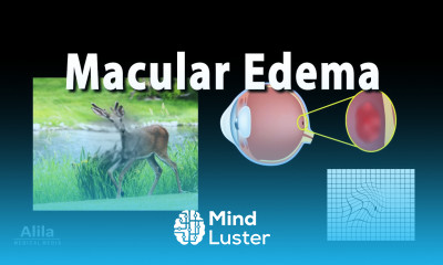 Macular Edema Animation