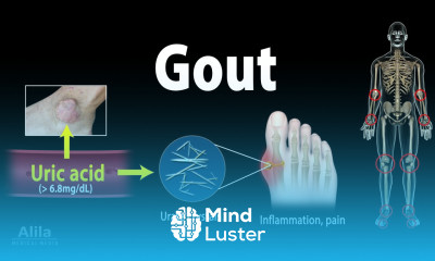 Gout Pathophysiology Causes Symptoms Risk Factors Diagnosis and Treatments Animation