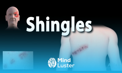 Shingles Pathophysiology Symptoms 3 stages of Infection Complications Management Animation