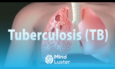 Tuberculosis TB Progression of the Disease Latent and Active Infections