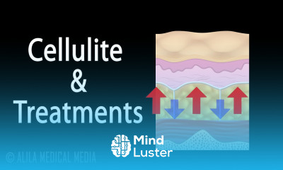 Cellulite and Treatment Options incl Cellulaze Animation