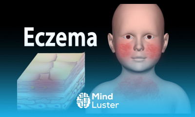 Eczema Animation