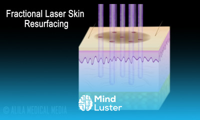 Traditional versus Fractional Laser Skin Resurfacing Procedure Animation