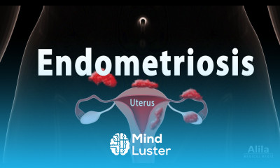 Endometriosis Pathology Symptoms Risk factors Diagnosis and Treatment Animation