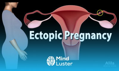 Ectopic Pregnancy Animation