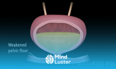 Stress Urinary Incontinence in Women Animation